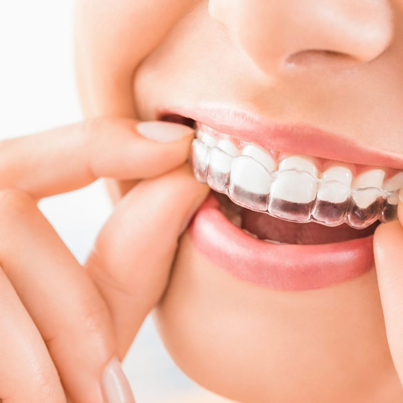 invisalign